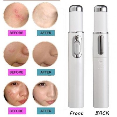 Beauty Instrument Blue Light Therapy Laser Pointer Remove Acne Scars  Anti-Wrinkle Face Tr